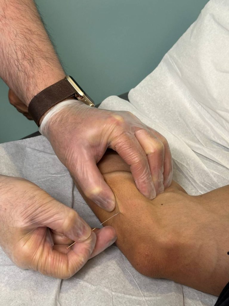 Dry Needling,